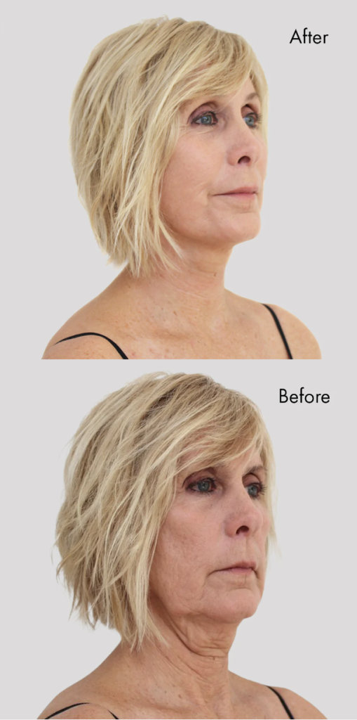 Bring It Up | Instant Neck Lift